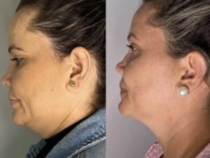 pcdc fat dissolving injections chin results